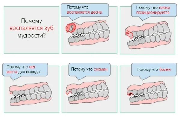 Что делать после удаления зуба мудрости?