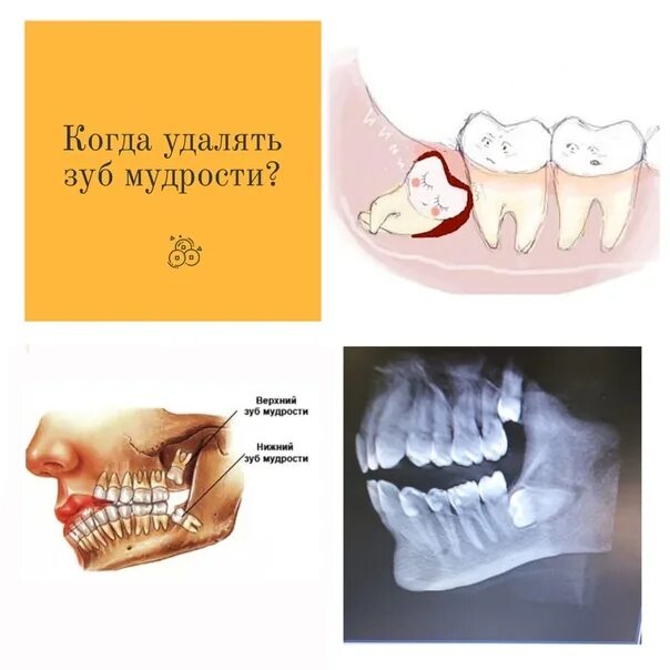 Правильный зуб мудрости фото Где находится зуб мудрости у человека на нижней челюсти - Арт Минск.ру