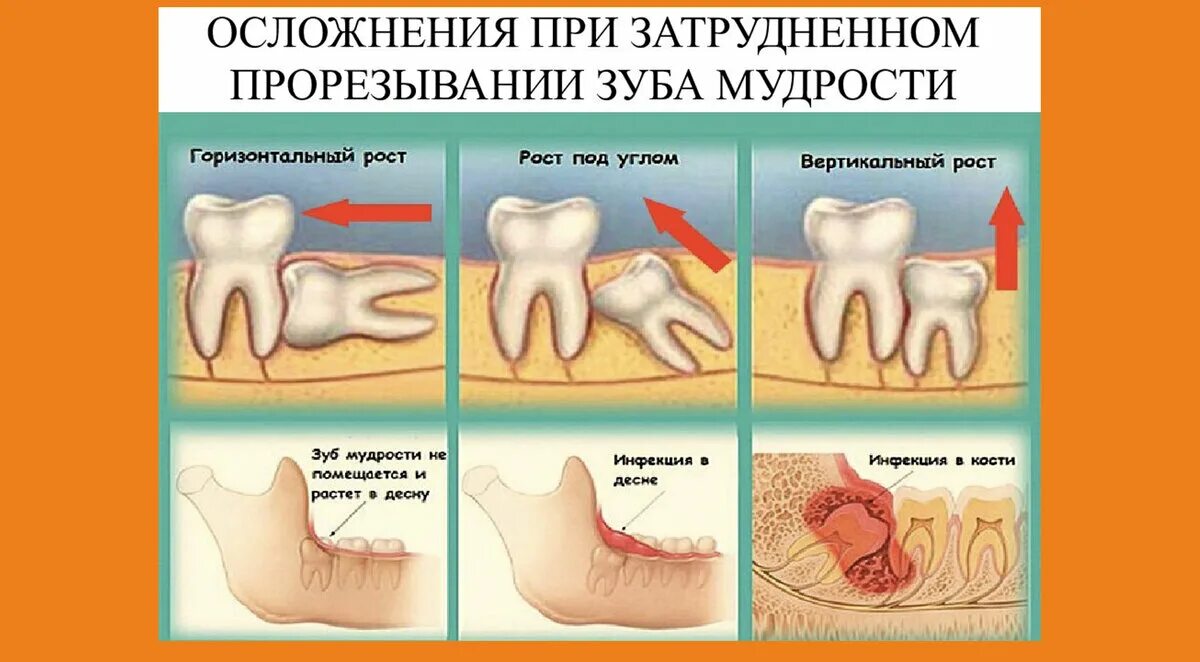 Правильный зуб мудрости фото Почему болит зуб? 7 возможных причин. ZiZi Dent Авторская стоматология Дзен