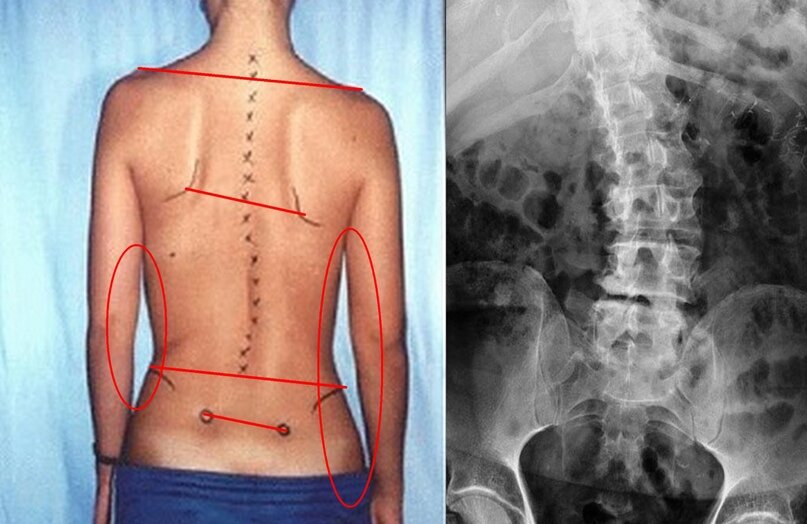Правосторонний сколиоз грудного отдела фото Сколиоз поясничного отдела позвоночника Движение без боли Дзен