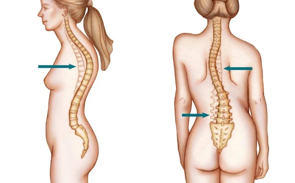 Правосторонний сколиоз грудного отдела позвоночника фото Кифосколиоз: симптомы и лечение Артракам