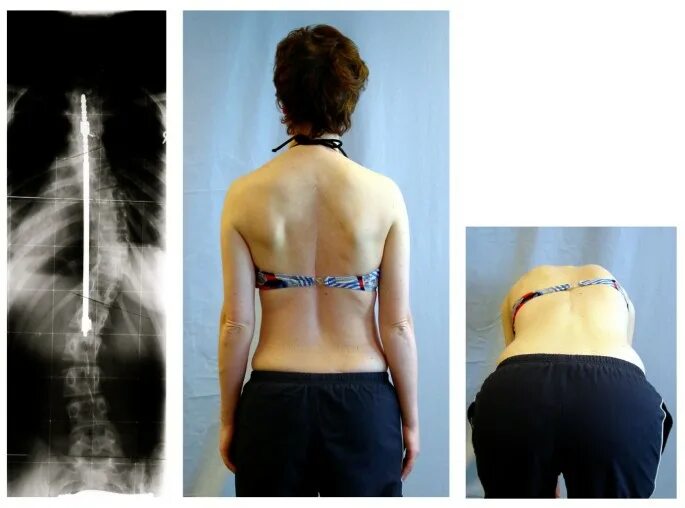 Правосторонний сколиоз грудного отдела позвоночника фото Rate of complications in scoliosis surgery - a systematic review of the Pub Med 