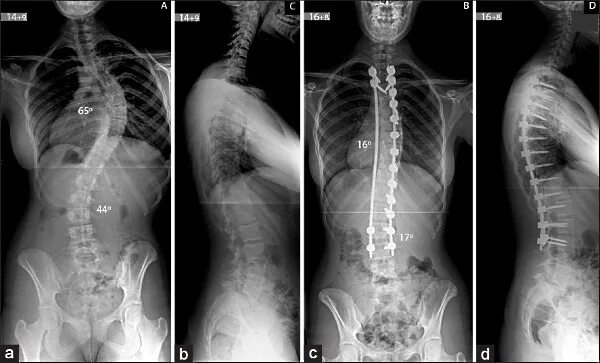 Правосторонний сколиоз грудного отдела позвоночника фото Правосторонний сколиоз грудного отдела позвоночника. Упражнения при правосторонн