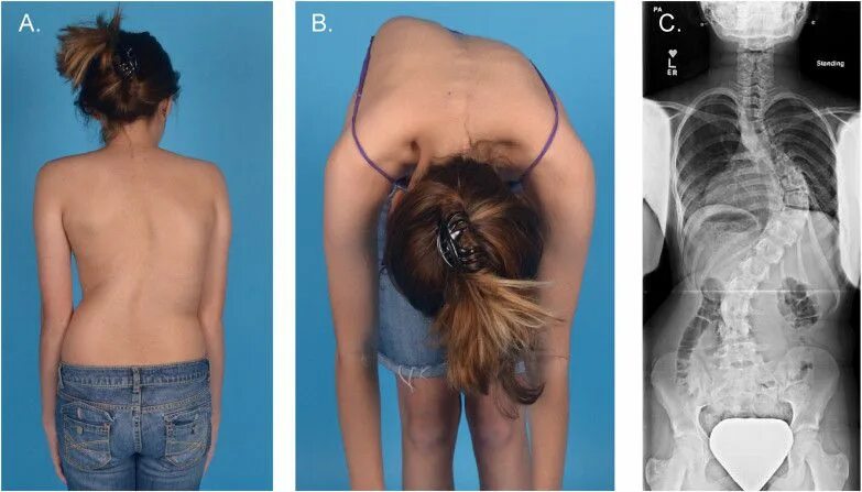 Правосторонний сколиоз грудного отдела позвоночника фото Боль у мужчин в области поясницы лечение, причины, симптомы, защемление нерва кл