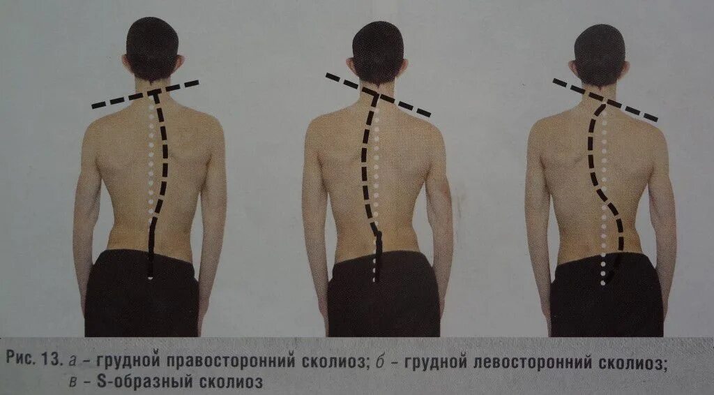 Правосторонний сколиоз грудного отдела позвоночника фото Как называется стойкое боковое искривление позвоночника