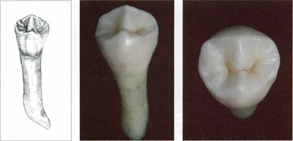 Премоляры верхней челюсти фото Мои работы. Wax-Up Основной альбом - 8 фотографий ВКонтакте