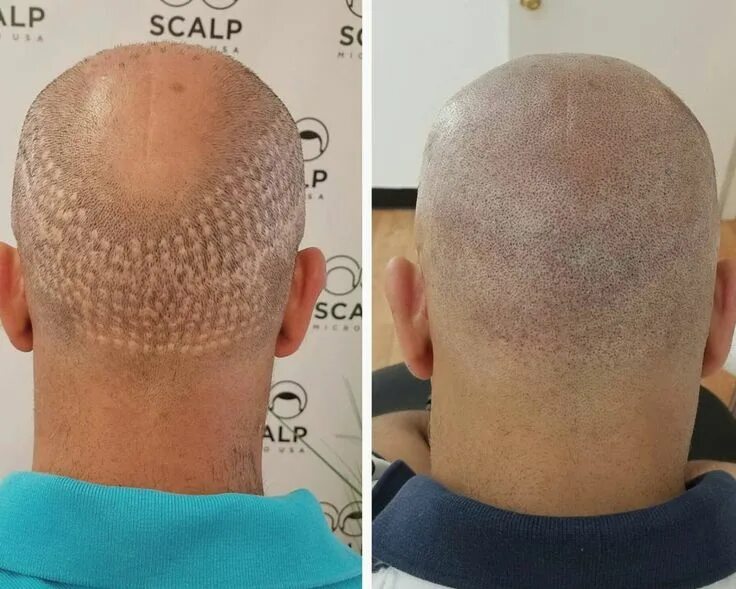 Прическа озеро в лесу фото Hair Transplant on (con imágenes) Cejas