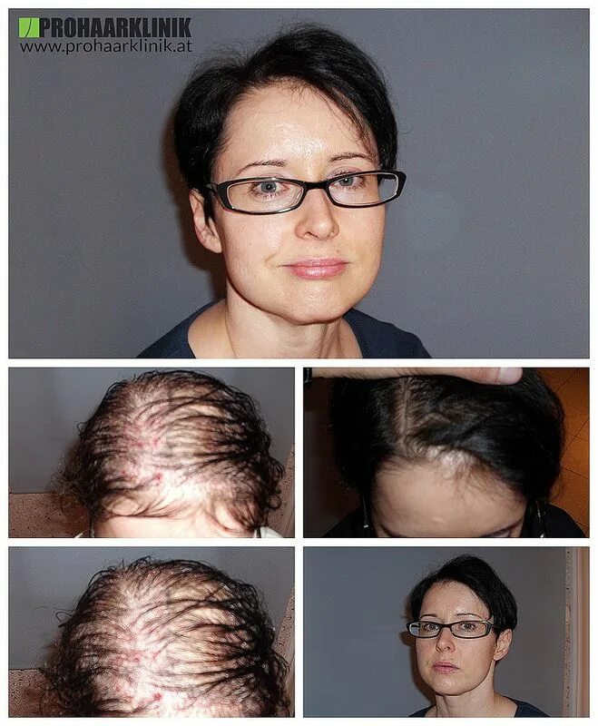 Прическа при алопеции для женщин Haartransplantation für Frauen 3500+ Haare - PROHAARKLINIK Hair implants, Hair c