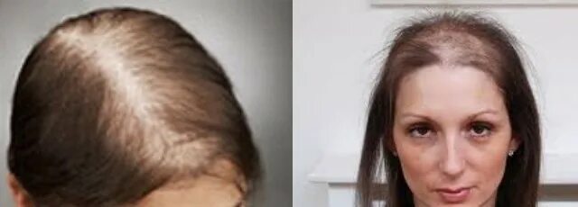 Прическа при алопеции для женщин Hair loss: what means will help to stop hair loss