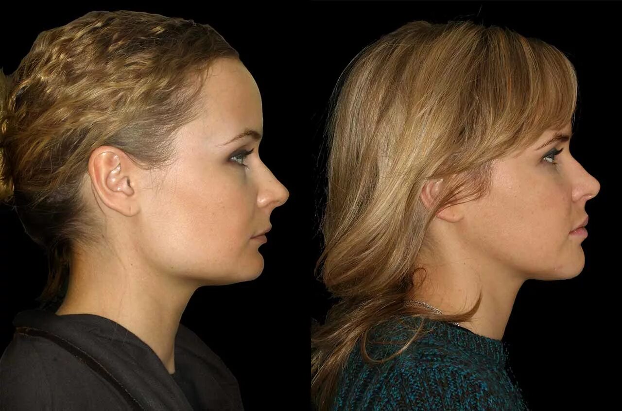 Прическа скрывающая длинный нос Orthognathic Facial Asymmetry Correction - Corrective Jaw Surgery - Dr. Antipov