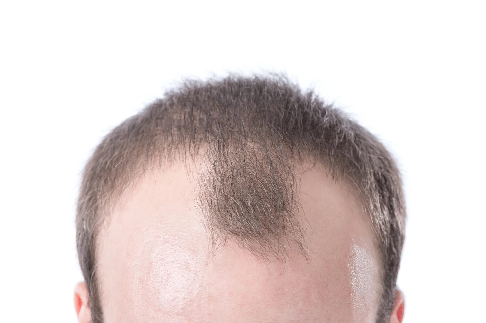 Прически мужские лысина What is an Uneven Hairline & How Can You Do About It? - Revela