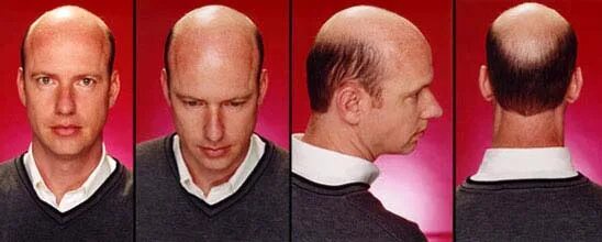 Прически мужские лысина Male Pattern Baldness Hereditary - FREE PATTERNS