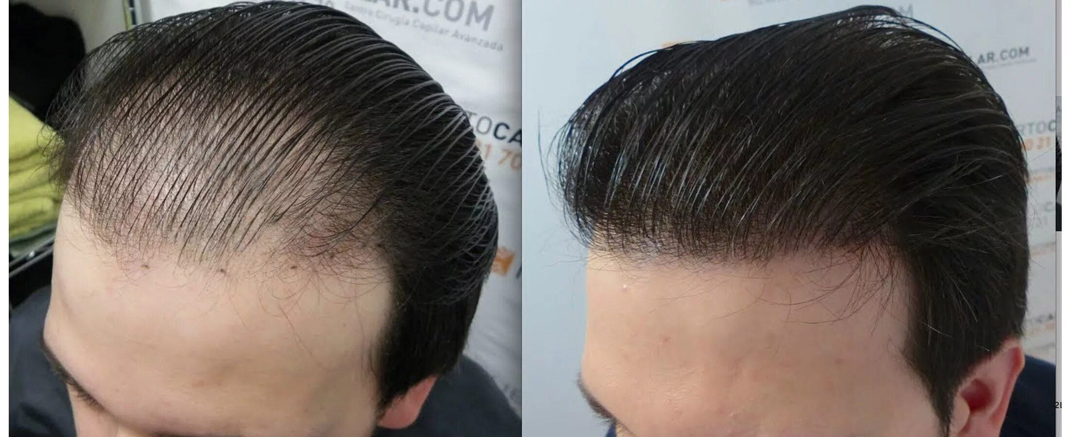 Прически растут волосы Side effects of a hair transplant Hair transplant surgery, Hair transplant cost,