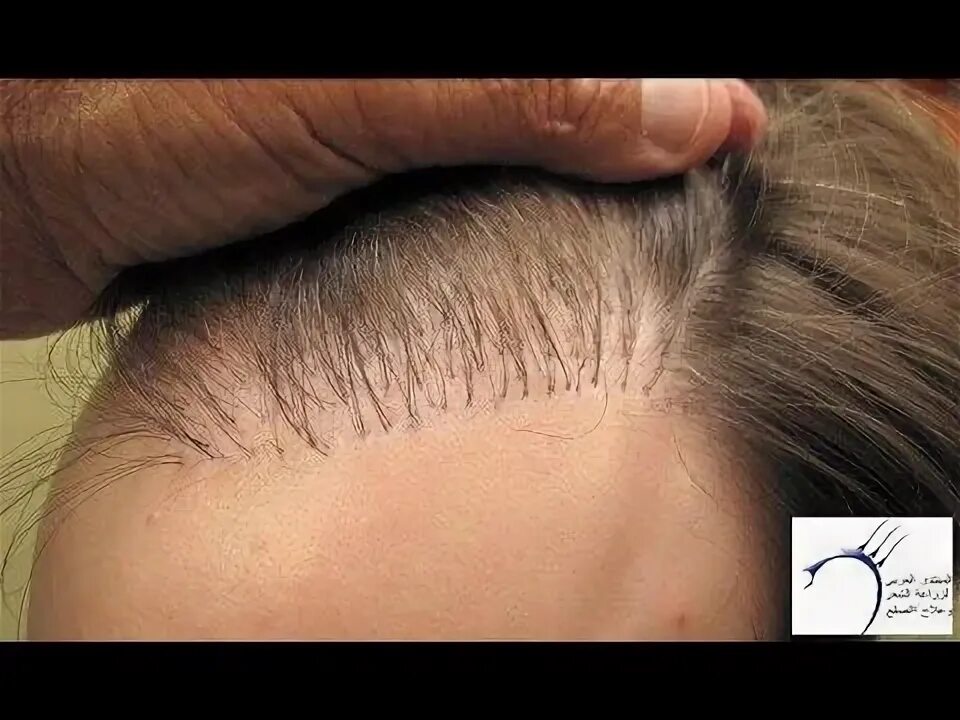 Прически растут волосы زراعة الشعر, زرع الشعر واضراره على الانسان, زراعة الشعر في ايران زراعة الشعر Hai