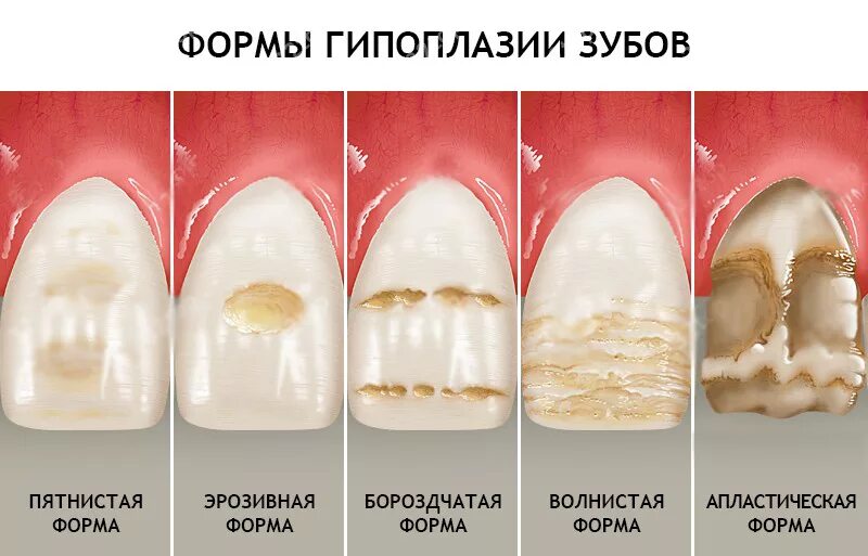 Причина на зубов фото Белые пятна на зубах: причины и последствия