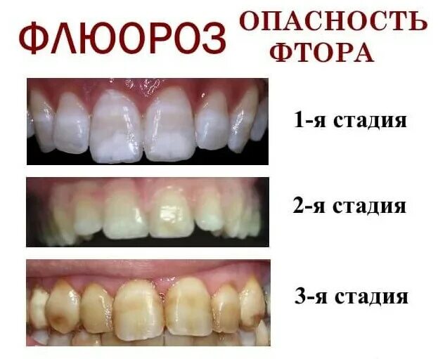 Причина на зубов фото Профилактика и лечение флюороза "Стоматолог и Я"