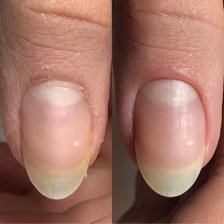 What Can Nail Changes Say About Our Health? Here's What To Know IFLScience