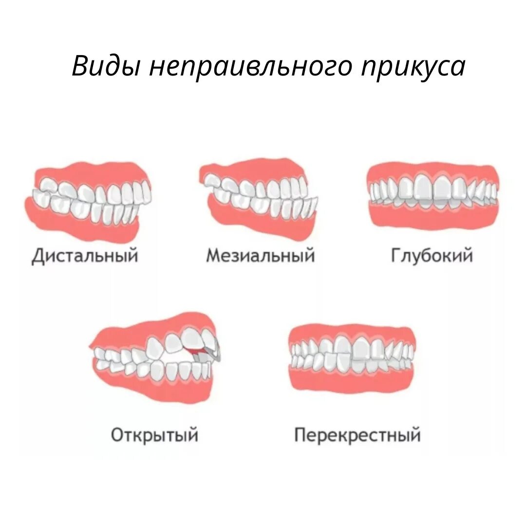 Прикус зубов фото What types of malocclusion are conditionally distinguished? 1. Open - jaws not c