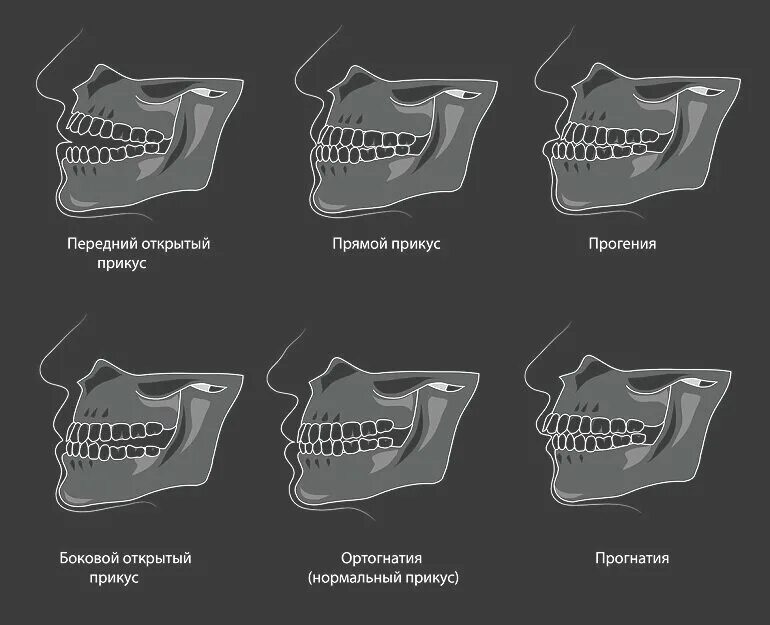 Прикус зубов правильный и неправильный фото Проверить прикус. Тест. Ортодонт. Брекеты. Москва. Дзен
