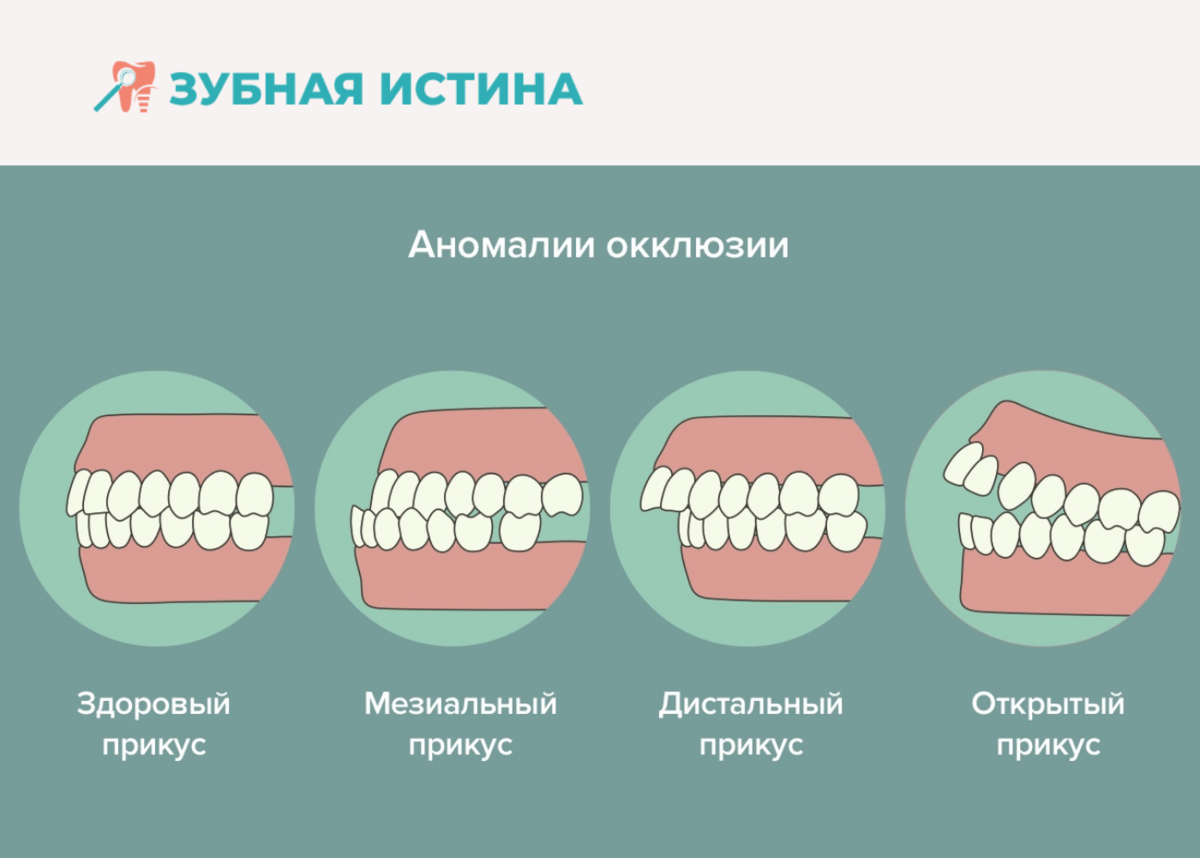 Прикус зубов правильный и неправильный фото Какие проблемы может вызвать неправильный прикус? Зубная истина Дзен