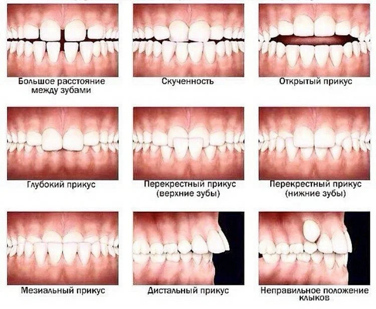 Виды неправильного прикуса. Прикус считается неправильным при аномалиях в. Стома