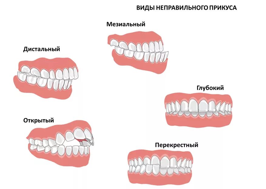 Прикус зубов правильный и неправильный фото Исправление прикуса у детей в стоматологической клинике Genesis