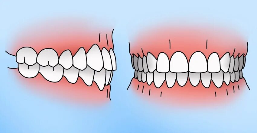 Прикус зубов правильный и неправильный фото Правильный прикус у человека: признаки, причины искажения и способы коррекции