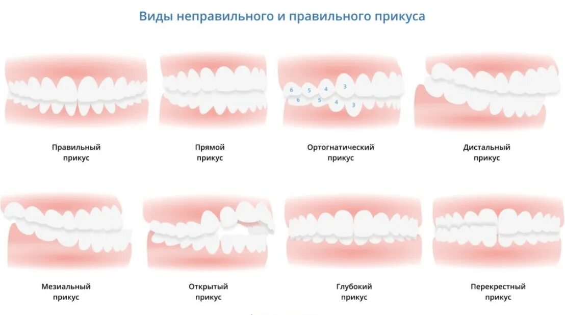 Прикус зубов правильный и неправильный фото Исправление прикуса у детей, взрослых в Минске, операция по исправлению прикуса,