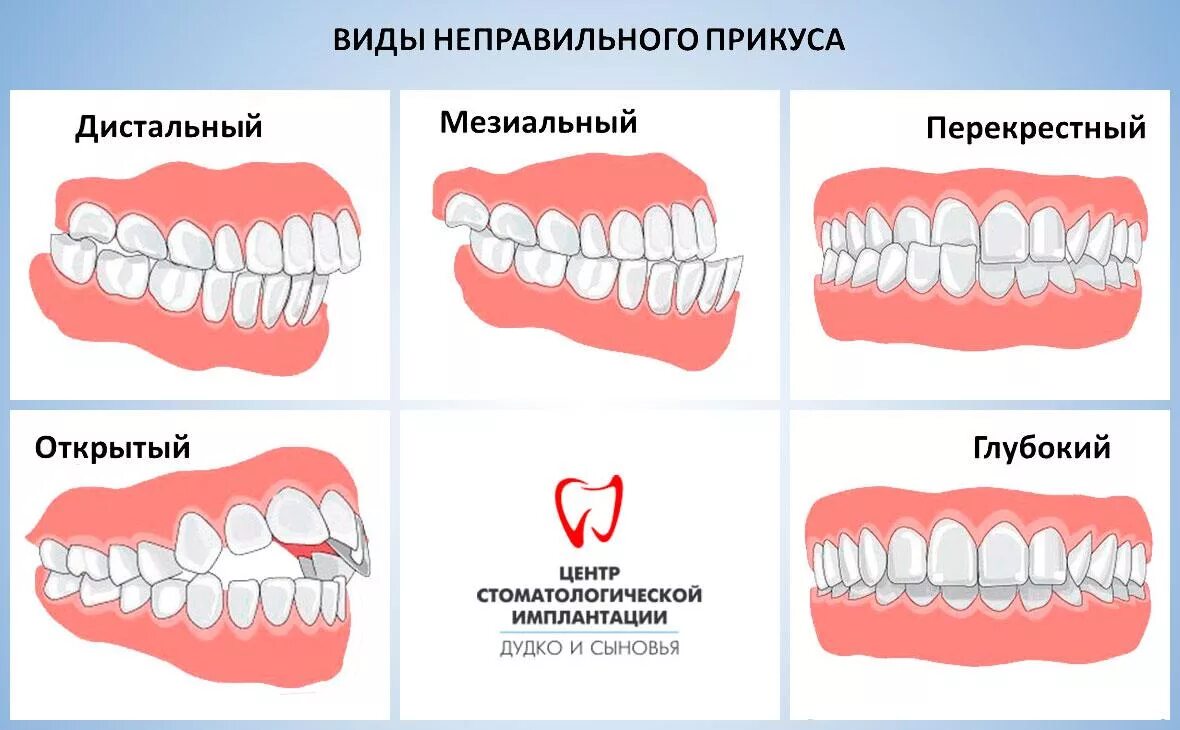 Прикус зубов правильный и неправильный фото Ortodoncja w Mińsku niski koszt w klinice Dudko i synowie