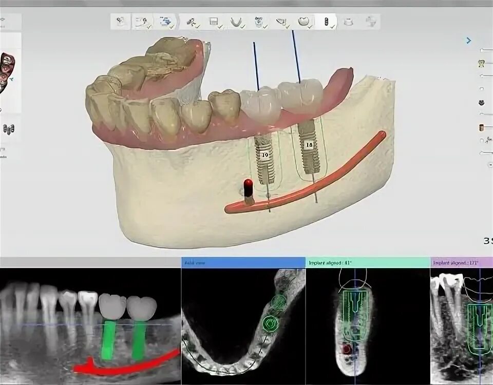 Приложение зубы на фото Софт для стоматологии Implant Studio - цена. В наличии.