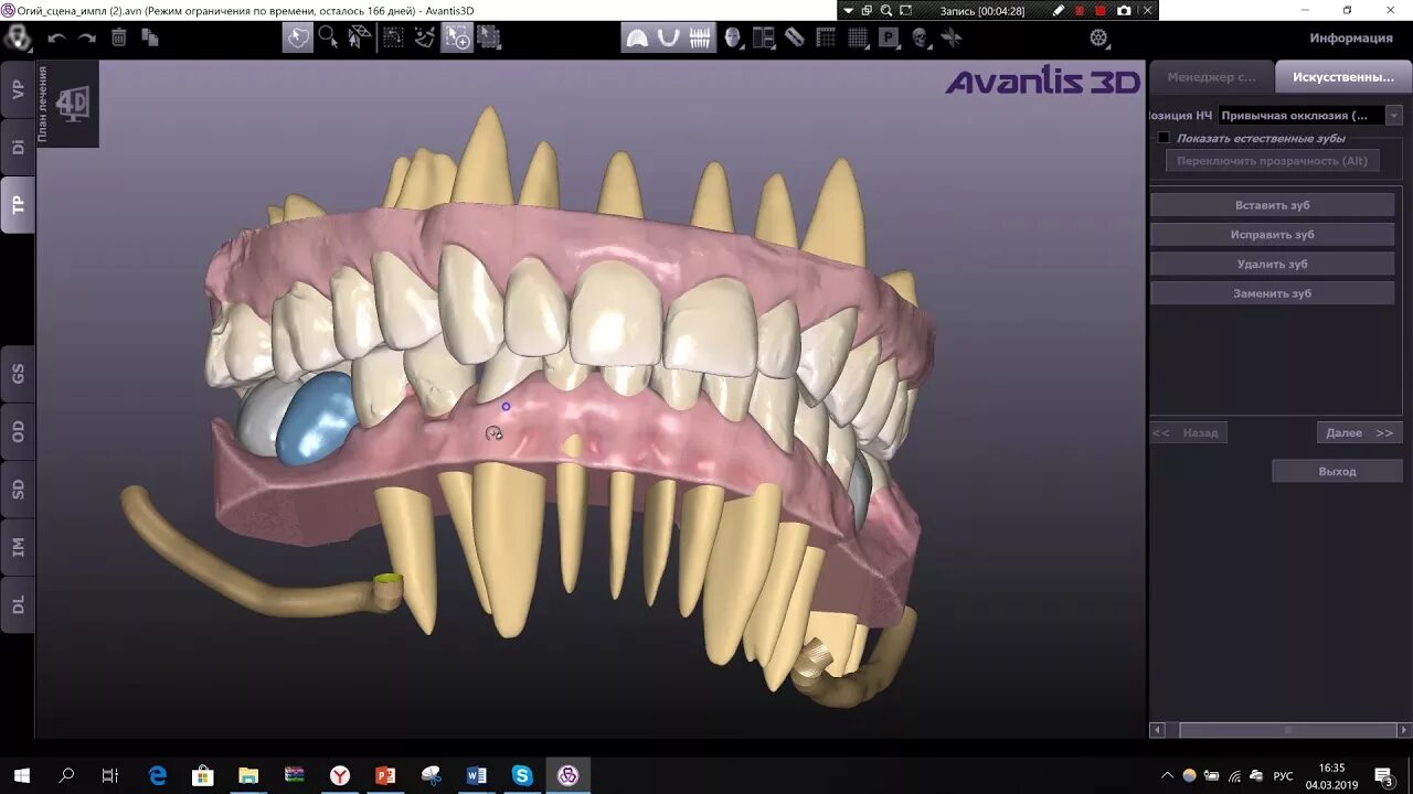 Приложение зубы на фото Расстановка зубов перед имплантацией_1 Avantis 3D - YouTube