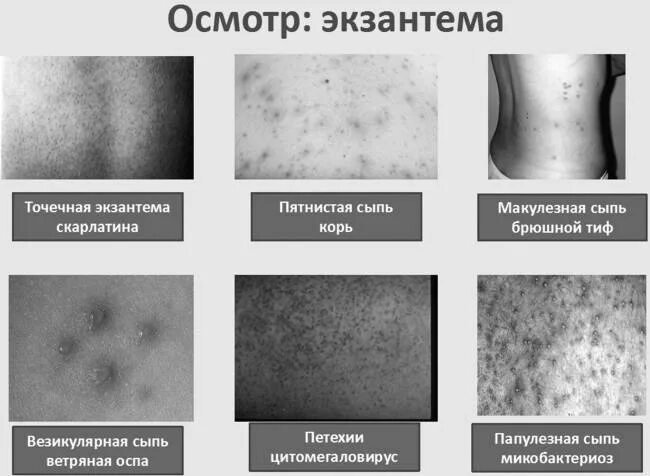 Примеры сыпи фото Ветрянка карта вызова 03