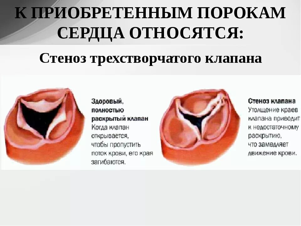 Приобретенные пороки сердца фото Стенозы и недостаточности клапанов сердца: найдено 90 изображений