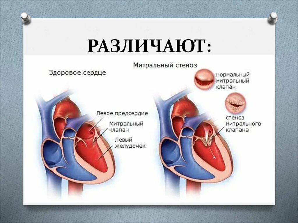 Приобретенные пороки сердца фото Митральные и аортальные пороки сердца: найдено 88 изображений