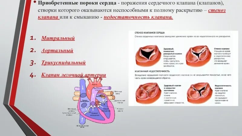 Приобретенные пороки сердца фото Приобретенные пороки сердца