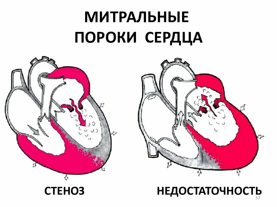 Приобретенные пороки сердца презентации