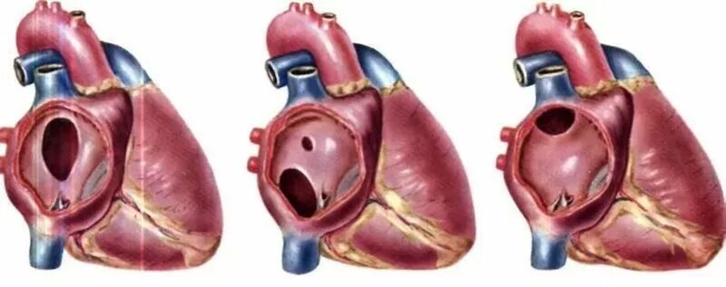 Приобретенные пороки сердца фото Порок сердца