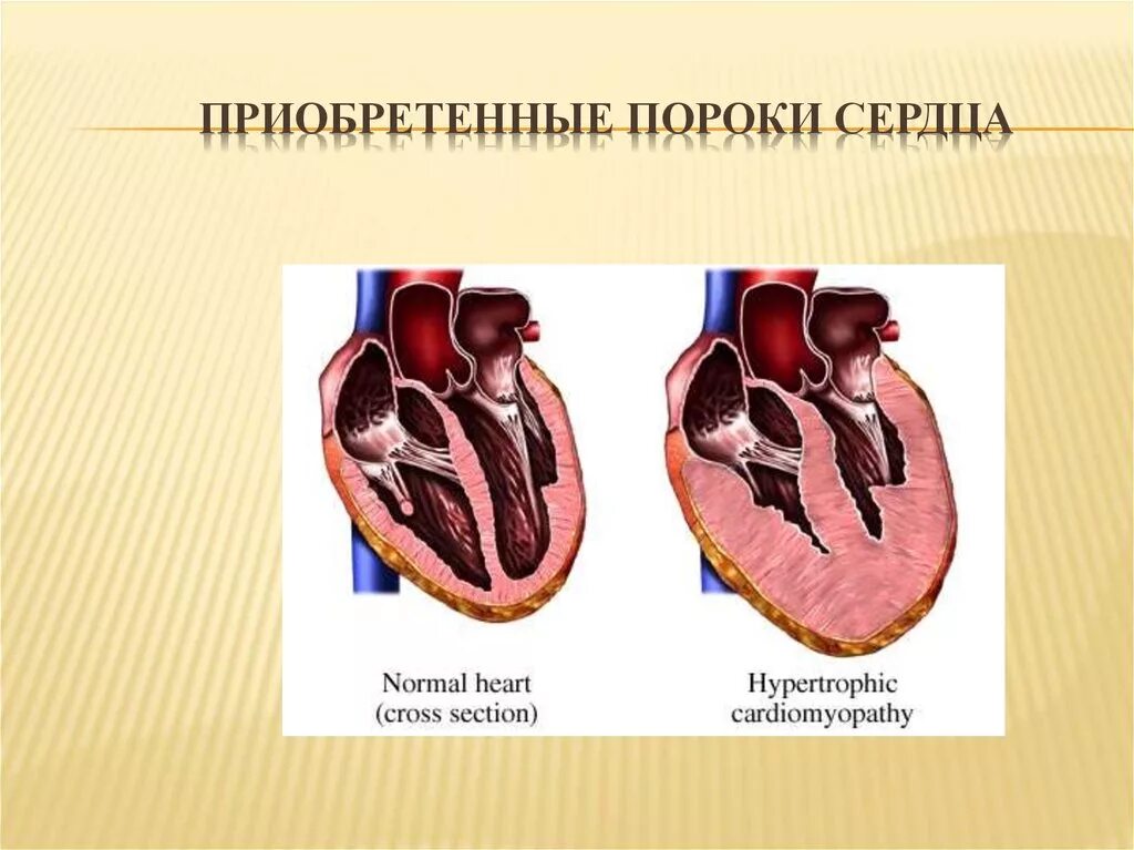 Приобретенные пороки сердца фото Приобретенные пороки сердца презентации