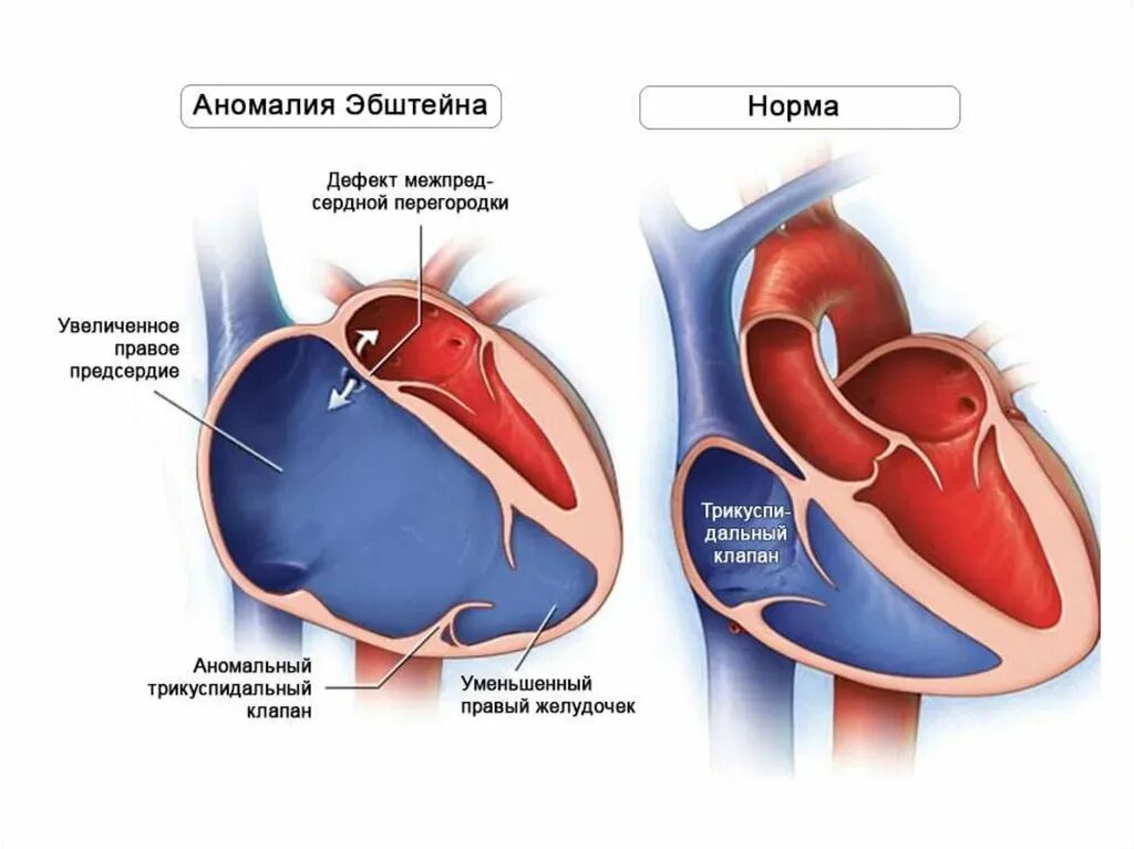 Приобретенные пороки сердца фото Аномалия Эбштейна - чем такой порок сердца грозит ребенку? О детском здоровье: с
