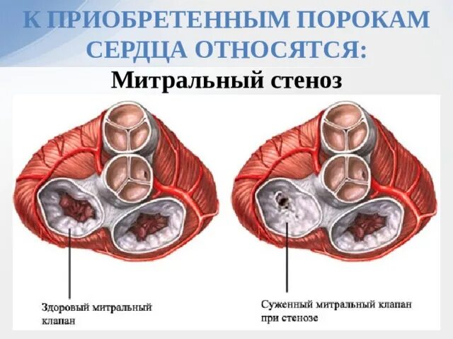 Приобретенные пороки сердца фото Сестринский уход при ревматизме, пороках сердца