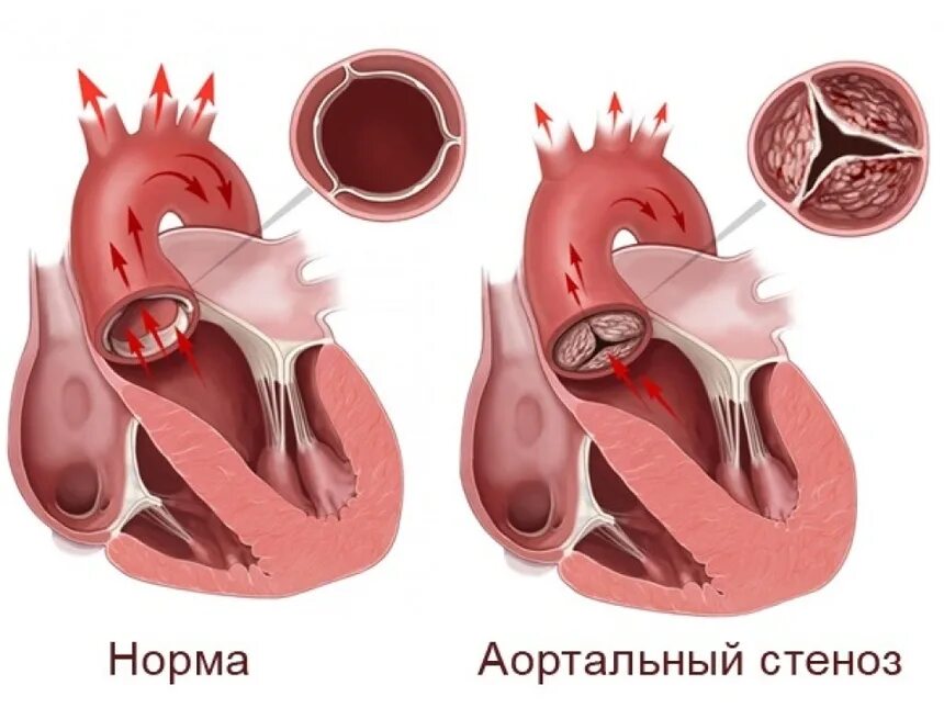 Приобретенные пороки сердца фото Новости и статьи от производителя медтехники "Новоком"