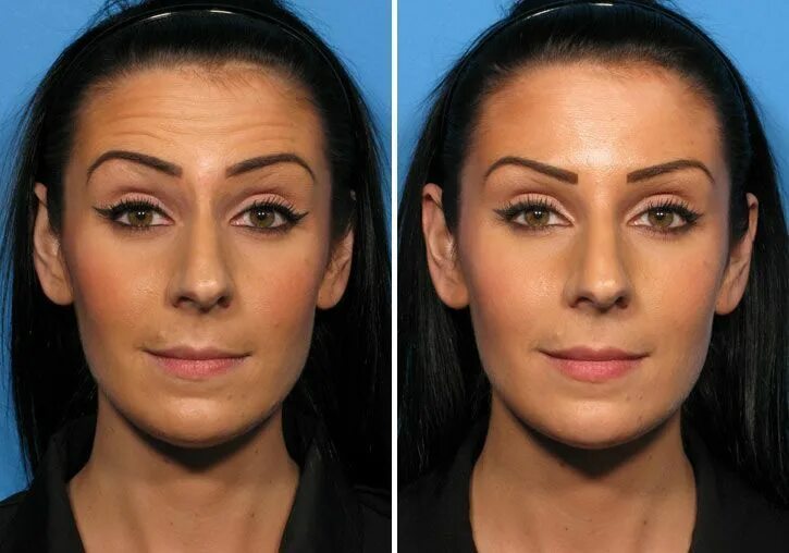 Приподнять брови ботоксом фото до и после botox before and after - Google Search #botoxbeforeandafter #BotoxResults Botox 