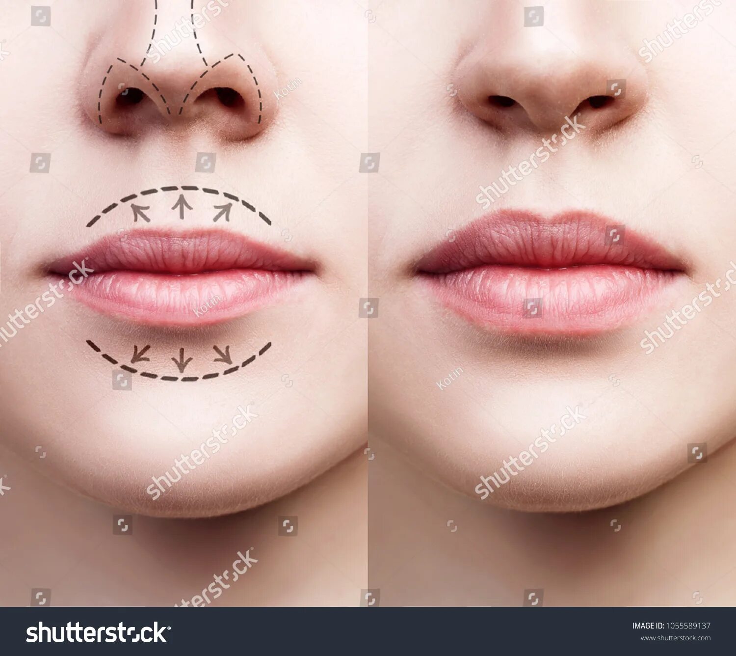 Приподнять уголки губ макияжем 62.684 Lips surgery Görseli, Stok Fotoğraflar ve Vektörler Shutterstock