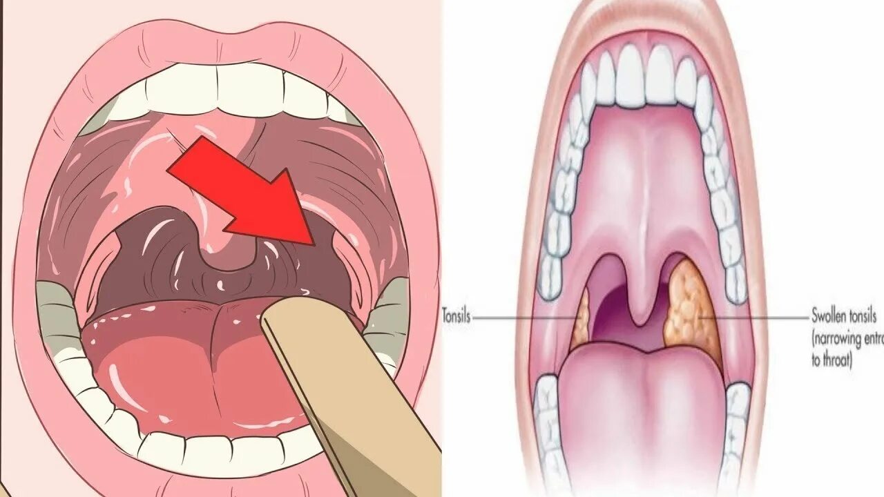 Припухлость в горле с одной стороны фото 5 Home Remedies To Remove Tonsil Stones! - YouTube