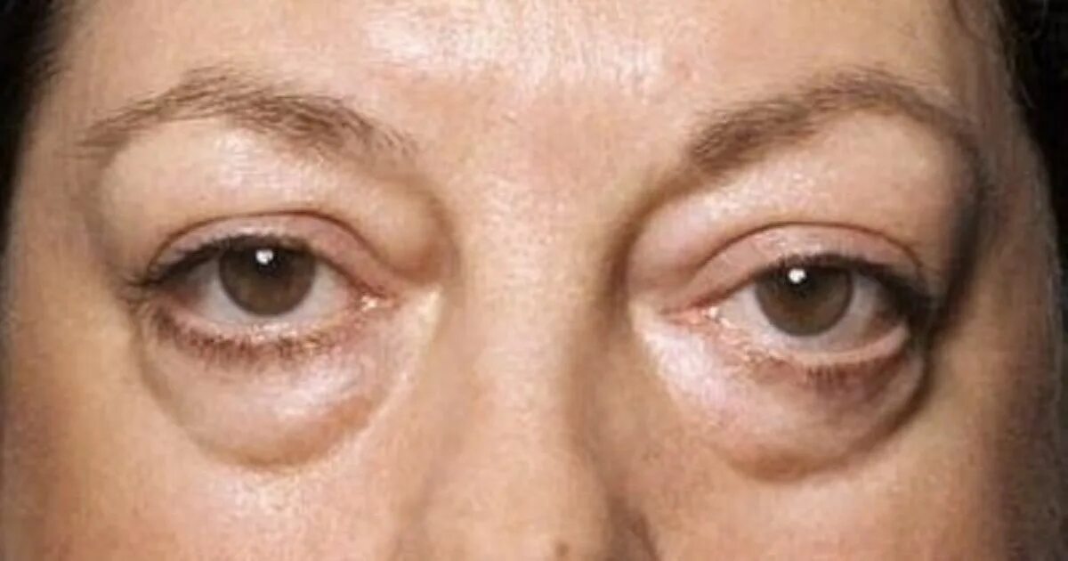 Припухлость век фото Get Help for Those Baggy Bags Under Your Eyes Eye bags, Under eye wrinkles, Beau