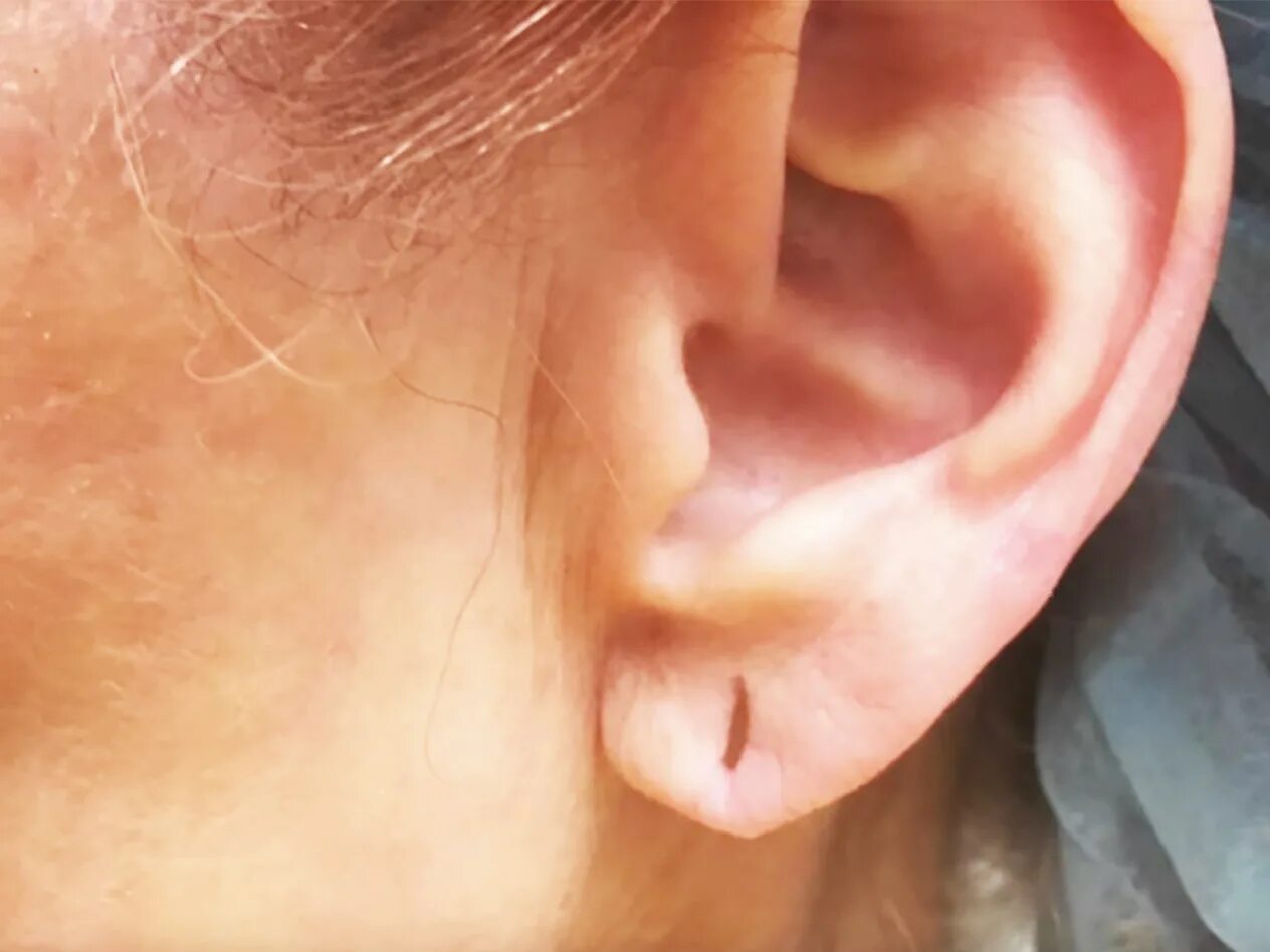 Приросшая мочка уха фото Yes, Heavy Earrings Can Permanently Stretch Out Your Earlobes SELF