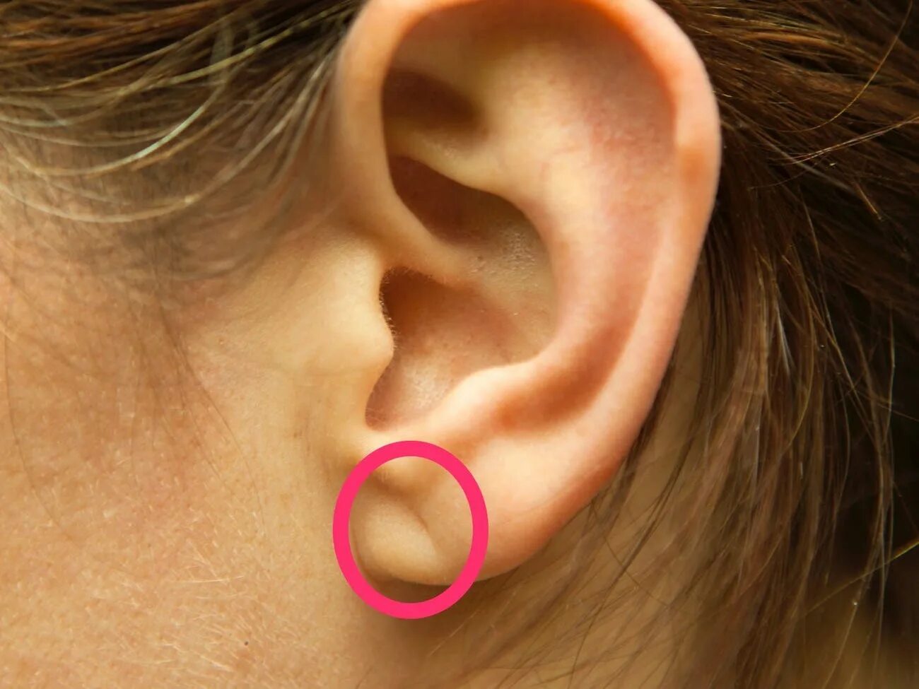 Приросшая мочка уха фото Earlobe Crease: How It Relates to Coronary Artery Disease