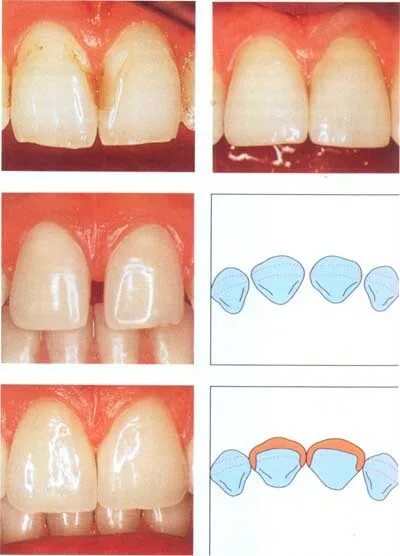Пришеечный кариес стадии фото Виниры Стоматология Запорожье