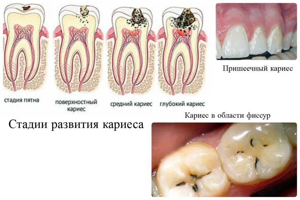 Пришеечный кариес стадии фото Поверхностный кариес зубов: причины, симптомы, методы лечения и диагностики, про