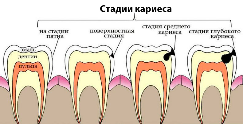 Пришеечный кариес стадии фото Стадии кариозной инфекции зубов - выявление и лечение